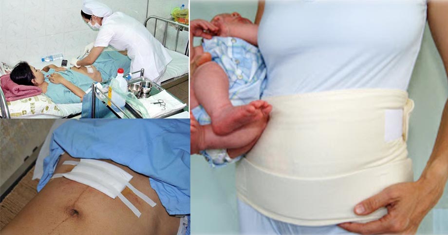 Chi tiết cách chăm sóc giúp vết mổ mau lành cho các mẹ sinh mổ