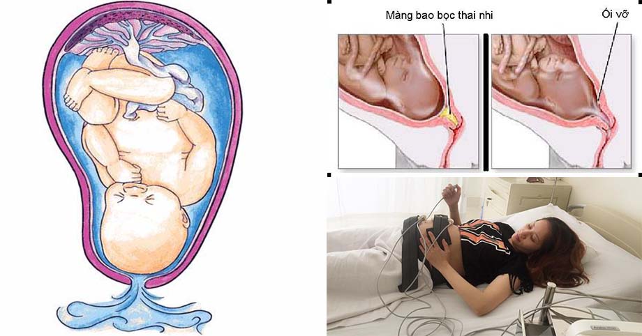 Bất ngờ vỡ ối - Mẹ bầu hãy bình tĩnh làm theo từng bước sau