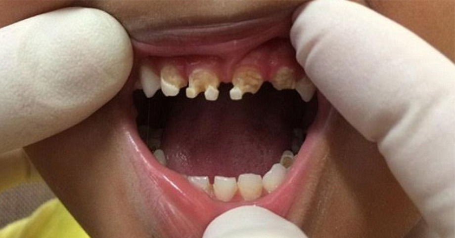Thói quen sai lầm của cha mẹ khiến răng con mủn nát, nhấp nhô, vàng khè